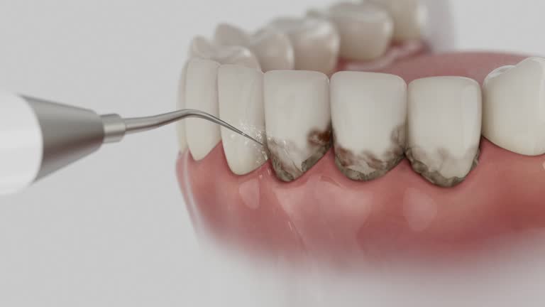 Trusted Wisdom Tooth Removal service in Riverwoods, IL - Dentist Open Now